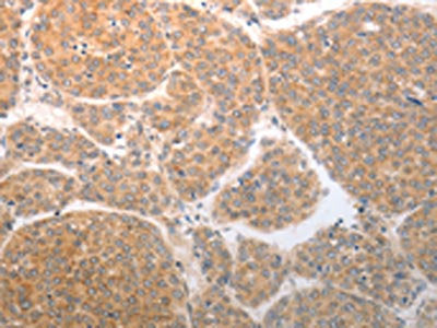 The image on the left is immunohistochemistry of paraffin-embedded Human liver cancer tissue using the antibody Antibody) at dilution 1/25, on the right is treated with synthetic peptide. (Original magnification: ×200)Rabbit anti-Human NQO1 Polyclonal Antibody