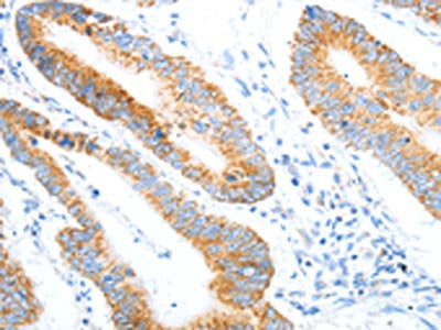 The image on the left is immunohistochemistry of paraffin-embedded Human colon cancer tissue using NTS Antibody(NTS Antibody) at dilution 1/20, on the right is treated with fusion protein. (Original magnification: ×200)Rabbit anti-Human NTS Polyclonal Antibody