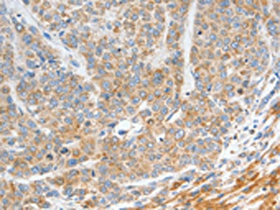 The image on the left is immunohistochemistry of paraffin-embedded Human gastic cancer tissue using the antibody Antibody) at dilution 1/20, on the right is treated with fusion protein. (Original magnification: ×200)Rabbit anti-Human NTS Polyclonal Antibody