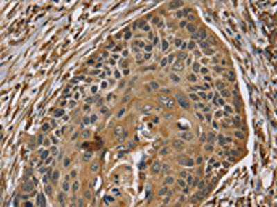 The image on the left is immunohistochemistry of paraffin-embedded Human esophagus cancer tissue using ZMIZ1 Antibody(ZMIZ1 Antibody) at dilution 1/40, on the right is treated with synthetic peptide. (Original magnification: ×200)Rabbit anti-Human ZMIZ1 Polyclonal Antibody