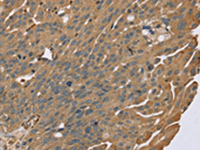 The image on the left is immunohistochemistry of paraffin-embedded Human breast cancer tissue using the antibody Antibody) at dilution 1/40, on the right is treated with synthetic peptide. (Original magnification: ×200)Rabbit anti-Human ZMIZ1 Polyclonal Antibody