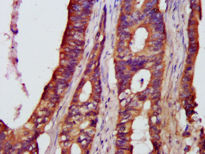 IHC image of NFKB1 Antibody diluted at 1:500 and staining in paraffin-embedded human colon cancer performed on a Leica BondTM system. After dewaxing and hydration, antigen retrieval was mediated by high pressure in a citrate buffer (pH 6.0). Section was blocked with 10% normal goat serum 30min at RT. Then primary antibody (1% BSA) was incubated at 4°C overnight. The primary is detected by a biotinylated secondary antibody and visualized using an HRP conjugated SP system.Rabbit anti-Human NFKB1 Polyclonal Antibody