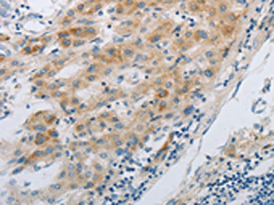 The image on the left is immunohistochemistry of paraffin-embedded Human liver cancer tissue using GJB6 Antibody(GJB6 Antibody) at dilution 1/30, on the right is treated with synthetic peptide. (Original magnification: ×200)Rabbit anti-Human GJB6 Polyclonal Antibody