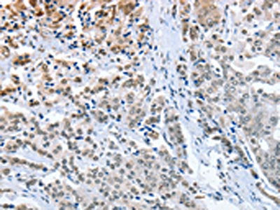 The image on the left is immunohistochemistry of paraffin-embedded Human prostate cancer tissue using ELAVL1 Antibody(ELAVL1 Antibody) at dilution 1/50, on the right is treated with fusion protein. (Original magnification: ×200)Rabbit anti-Human ELAVL1 Polyclonal Antibody