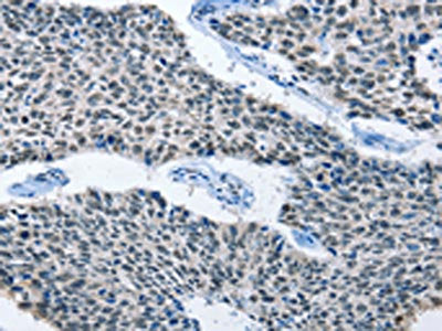 The image on the left is immunohistochemistry of paraffin-embedded Human lung cancer tissue using the antibody Antibody) at dilution 1/50, on the right is treated with fusion protein. (Original magnification: ×200)Rabbit anti-Human ELAVL1 Polyclonal Antibody