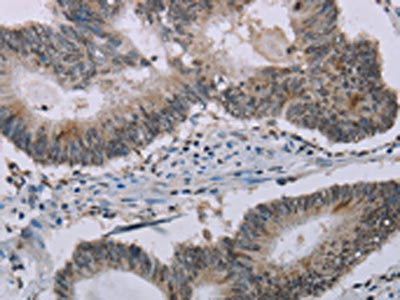 The image on the left is immunohistochemistry of paraffin-embedded Human colon cancer tissue using MMP20 Antibody(MMP20 Antibody) at dilution 1/30, on the right is treated with synthetic peptide. (Original magnification: ×200)Rabbit anti-Human MMP20 Polyclonal Antibody