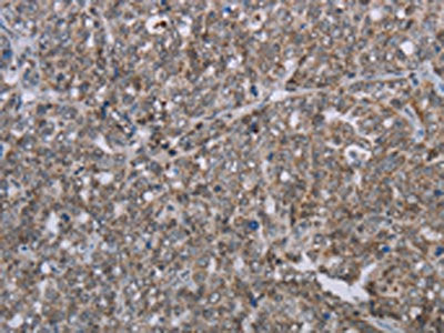 The image on the left is immunohistochemistry of paraffin-embedded Human ovarian cancer tissue using the antibody Antibody) at dilution 1/30, on the right is treated with synthetic peptide. (Original magnification: ×200)