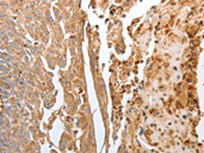 The image on the left is immunohistochemistry of paraffin-embedded Human cervical cancer tissue using NPY1R Antibody(NPY1R Antibody) at dilution 1/30, on the right is treated with synthetic peptide. (Original magnification: ×200)Rabbit anti-Human NPY1R Polyclonal Antibody