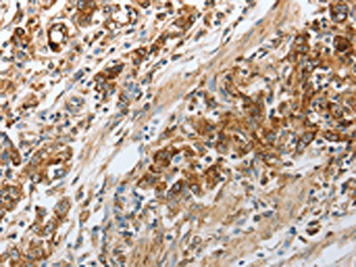 The image on the left is immunohistochemistry of paraffin-embedded Human gastic cancer tissue using the antibody Antibody) at dilution 1/30, on the right is treated with synthetic peptide. (Original magnification: ×200)Rabbit anti-Human NPY1R Polyclonal Antibody