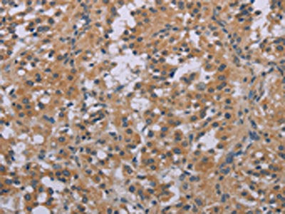 The image on the left is immunohistochemistry of paraffin-embedded Human thyroid cancer tissue using the antibody Antibody) at dilution 1/20, on the right is treated with synthetic peptide. (Original magnification: ×200)
