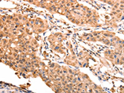 The image on the left is immunohistochemistry of paraffin-embedded Human lung cancer tissue using ACO2 Antibody(ACO2 Antibody) at dilution 1/30, on the right is treated with synthetic peptide. (Original magnification: ×200)