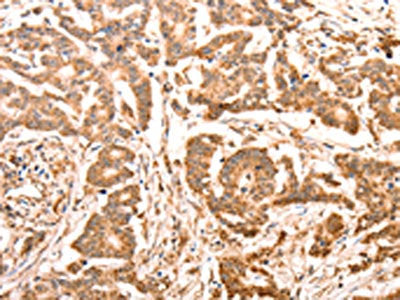 The image on the left is immunohistochemistry of paraffin-embedded Human colon cancer tissue using the antibody Antibody) at dilution 1/30, on the right is treated with synthetic peptide. (Original magnification: ×200)