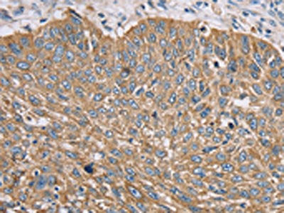 The image on the left is immunohistochemistry of paraffin-embedded Human lung cancer tissue using the antibody Antibody) at dilution 1/35, on the right is treated with synthetic peptide. (Original magnification: ×200)Rabbit anti-Human TFRC Polyclonal Antibody