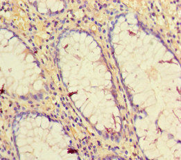 Immunohistochemistry of paraffin-embedded human colon cancer using CD34 Antibody at dilution of 1:100Rabbit anti-Human CD34 Polyclonal Antibody
