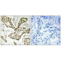 Immunohistochemistry analysis of paraffin-embedded human liver carcinoma tissue using TOP2A antibody.Rabbit anti-Human TOP2A Polyclonal Antibody
