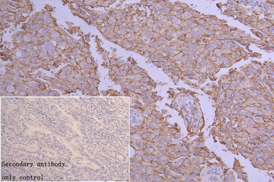 Immunohistochemistry of paraffin-embedded human colon cancer using CD9 Antibody at dilution of 1:100Rabbit anti-Human CD9 Polyclonal Antibody
