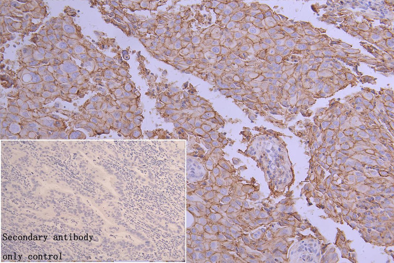 Immunohistochemistry of paraffin-embedded human colon cancer using CD9 Antibody at dilution of 1:100Rabbit anti-Human CD9 Polyclonal Antibody