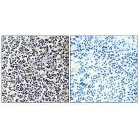 Immunohistochemistry analysis of paraffin-embedded human lung carcinoma tissue using TACC3 antibody.