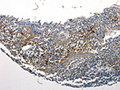 The image is immunohistochemistry of paraffin-embedded Human tonsil tissue using STAT5B Antibody(STAT5B Antibody) at dilution 1/25. (Original magnification: ×200)Rabbit anti-Human STAT5B Polyclonal Antibody