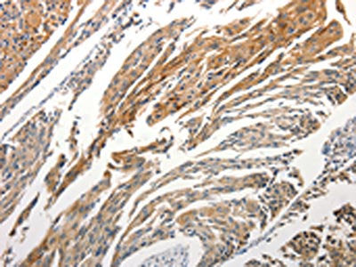 The image is immunohistochemistry of paraffin-embedded Human cervical cancer tissue using the antibody Antibody) at dilution 1/25. (Original magnification: ×200)Rabbit anti-Human STAT5B Polyclonal Antibody
