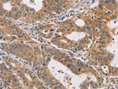 The image on the left is immunohistochemistry of paraffin-embedded Human gastric cancer tissue using CDK11A/CDK11B Antibody(CDK11A/CDK11B Antibody) at dilution 1/40, on the right is treated with synthetic peptide. (Original magnification: ×200)Rabbit anti-Human CDK11A/CDK11B Polyclonal Antibody