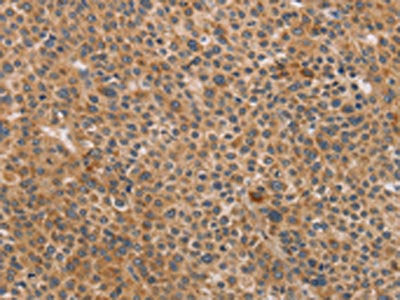 The image on the left is immunohistochemistry of paraffin-embedded Human liver cancer tissue using the antibody Antibody) at dilution 1/40, on the right is treated with synthetic peptide. (Original magnification: ×200)Rabbit anti-Human CDK11A/CDK11B Polyclonal Antibody