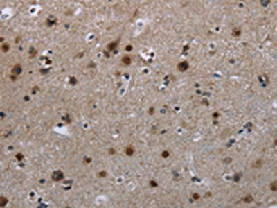 The image on the left is immunohistochemistry of paraffin-embedded Human brain  tissue using CFLAR Antibody(CFLAR Antibody) at dilution 1/20, on the right is treated with synthetic peptide. (Original magnification: ×200)Rabbit anti-Human CFLAR Polyclonal Antibody