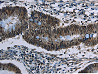 The image on the left is immunohistochemistry of paraffin-embedded Human colon cancer tissue using the antibody Antibody) at dilution 1/20, on the right is treated with synthetic peptide. (Original magnification: ×200)Rabbit anti-Human CFLAR Polyclonal Antibody