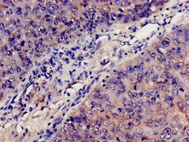 Immunohistochemistry analysis of human cervical cancer using the antibody at dilution of 1:100