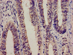 Immunohistochemistry analysis of human colon cancer using C3 Antibody at dilution of 1:100
