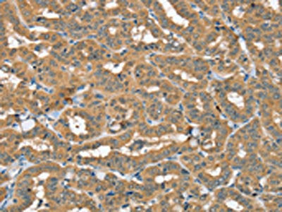 The image on the left is immunohistochemistry of paraffin-embedded Human thyroid cancer tissue using SEC14L2 Antibody(SEC14L2 Antibody) at dilution 1/40, on the right is treated with synthetic peptide. (Original magnification: ×200)Rabbit anti-Human SEC14L2 Polyclonal Antibody