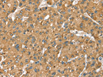 The image on the left is immunohistochemistry of paraffin-embedded Human liver cancer tissue using the antibody Antibody) at dilution 1/40, on the right is treated with synthetic peptide. (Original magnification: ×200)Rabbit anti-Human SEC14L2 Polyclonal Antibody