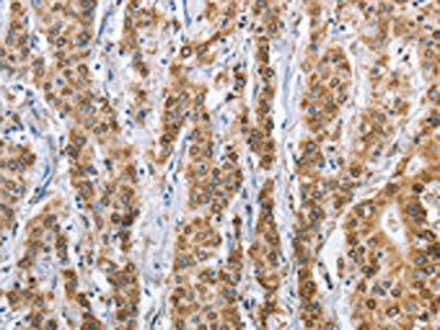 The image on the left is immunohistochemistry of paraffin-embedded Human gastric cancer tissue using CANX Antibody(CANX Antibody) at dilution 1/40, on the right is treated with fusion protein. (Original magnification: ×200)