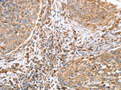 The image on the left is immunohistochemistry of paraffin-embedded Human cervical cancer tissue using the antibody Antibody) at dilution 1/40, on the right is treated with fusion protein. (Original magnification: ×200)