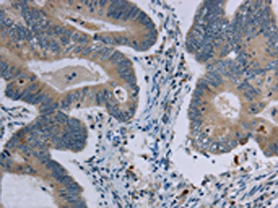 The image on the left is immunohistochemistry of paraffin-embedded Human colon cancer tissue using MARVELD1 Antibody(MARVELD1 Antibody) at dilution 1/40, on the right is treated with synthetic peptide. (Original magnification: ×200)