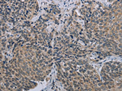 The image on the left is immunohistochemistry of paraffin-embedded Human cervical cancer tissue using the antibody Antibody) at dilution 1/40, on the right is treated with synthetic peptide. (Original magnification: ×200)