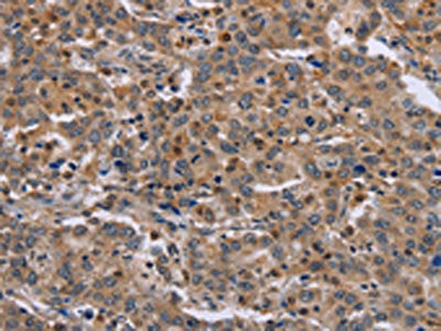 The image on the left is immunohistochemistry of paraffin-embedded Human liver cancer tissue using ETV7 Antibody(ETV7 Antibody) at dilution 1/30, on the right is treated with fusion protein. (Original magnification: ×200)Rabbit anti-Human ETV7 Polyclonal Antibody