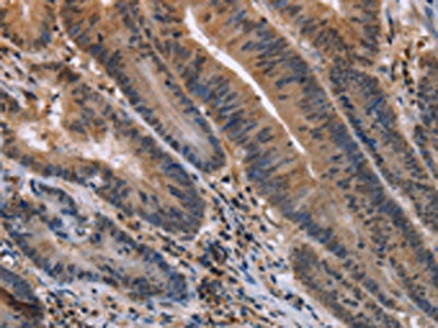 The image on the left is immunohistochemistry of paraffin-embedded Human colon cancer tissue using the antibody Antibody) at dilution 1/30, on the right is treated with fusion protein. (Original magnification: ×200)Rabbit anti-Human ETV7 Polyclonal Antibody