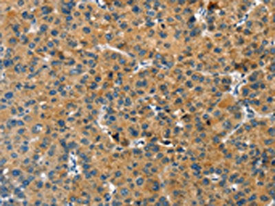 The image on the left is immunohistochemistry of paraffin-embedded Human liver cancer tissue using the antibody Antibody) at dilution 1/20, on the right is treated with fusion protein. (Original magnification: ×200)Rabbit anti-Human GNB2L1 Polyclonal Antibody