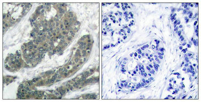 Immunohistochemical analysis of paraffin-embedded human breast carcinoma tissue using p62Dok(Ab-398) Antibody(left) or the same antibody preincubated with blocking peptide(right).Rabbit anti-Human DOK1 Polyclonal Antibody