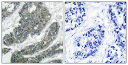 Immunohistochemical analysis of paraffin-embedded human breast carcinoma tissue using p62Dok(Ab-398) Antibody(left) or the same antibody preincubated with blocking peptide(right).Rabbit anti-Human DOK1 Polyclonal Antibody