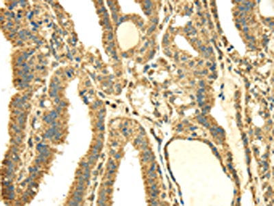 The image on the left is immunohistochemistry of paraffin-embedded Human thyroid cancer tissue using SDHA Antibody(SDHA Antibody) at dilution 1/40, on the right is treated with fusion protein. (Original magnification: ×200)Rabbit anti-Human SDHA Polyclonal Antibody