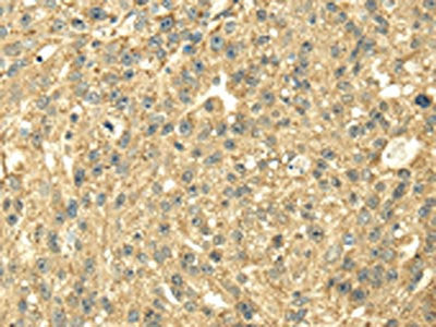 The image on the left is immunohistochemistry of paraffin-embedded Human breast cancer tissue using the antibody Antibody) at dilution 1/40, on the right is treated with fusion protein. (Original magnification: ×200)Rabbit anti-Human SDHA Polyclonal Antibody