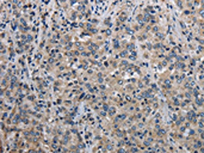 The image on the left is immunohistochemistry of paraffin-embedded Human liver cancer tissue using MCM3AP Antibody(MCM3AP Antibody) at dilution 1/30, on the right is treated with fusion protein. (Original magnification: ×200)