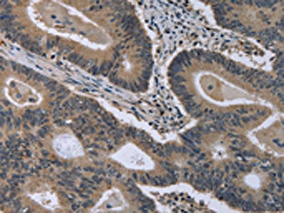 The image on the left is immunohistochemistry of paraffin-embedded Human colon cancer tissue using the antibody Antibody) at dilution 1/30, on the right is treated with fusion protein. (Original magnification: ×200)