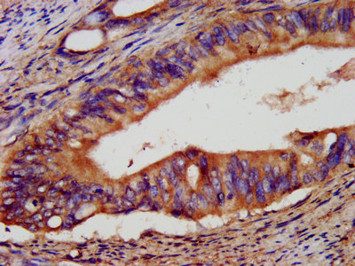 IHC image of EPCAM Antibody diluted at 1:400 and staining in paraffin-embedded human colon cancer performed on a Leica BondTM system. After dewaxing and hydration, antigen retrieval was mediated by high pressure in a citrate buffer (pH 6.0). Section was blocked with 10% normal goat serum 30min at RT. Then primary antibody (1% BSA) was incubated at 4°C overnight. The primary is detected by a biotinylated secondary antibody and visualized using an HRP conjugated SP system.Rabbit anti-Human EPCAM Polyclonal Antibody