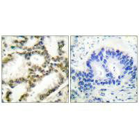 Immunohistochemical analysis of paraffin-embedded human lung carcinoma tissue using DJ-1 antibody.Rabbit anti-Human PARK7 Polyclonal Antibody