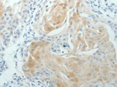 The image on the left is immunohistochemistry of paraffin-embedded Human cervical cancer tissue using RNF126 Antibody(RNF126 Antibody) at dilution 1/70, on the right is treated with synthetic peptide. (Original magnification: ×200)Rabbit anti-Human RNF126 Polyclonal Antibody