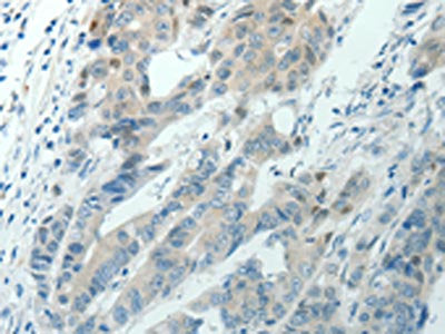 The image on the left is immunohistochemistry of paraffin-embedded Human colon cancer tissue using the antibody Antibody) at dilution 1/70, on the right is treated with synthetic peptide. (Original magnification: ×200)Rabbit anti-Human RNF126 Polyclonal Antibody