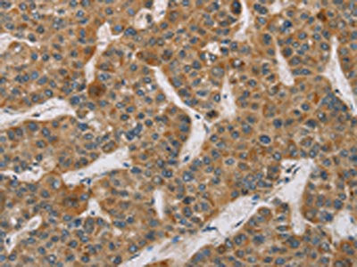 The image on the left is immunohistochemistry of paraffin-embedded Human liver cancer tissue using the antibody Antibody) at dilution 1/50, on the right is treated with fusion protein. (Original magnification: ×200)Rabbit anti-Human DCTN2 Polyclonal Antibody